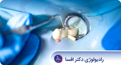 رادیوگرافی های مورد نیاز برای مدیریت درمان دندان های نهفته و دندان های عقل