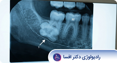 دندان نهفته چیست؟ علائم، علت و بهترین روش تصویربرداری برای تشخیص دندان نهفته